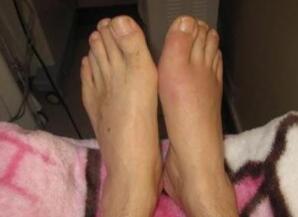 经过治疗后鲁建国的脚部症状已基本康复