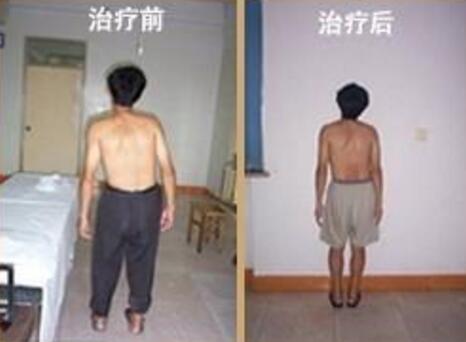山区教师患强直多年 因高额费用曾多次放弃治疗