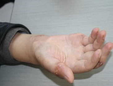 如何治疗脚后跟痛风这个问题？应该怎么办？